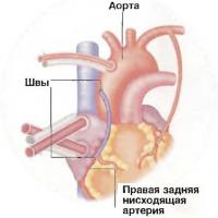 Окончание обоих процессов обходного шунтирования