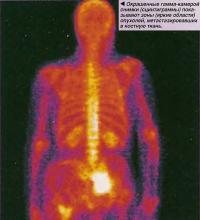 Окрашенные гамма-камерой снимки (сцинтиграммы) показывают зоны опухолей