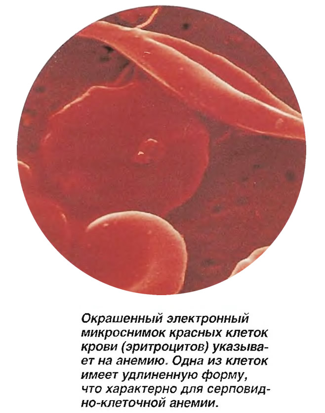 Окрашенный микроснимок красных клеток крови указывает на анемию