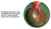 Операция включает в себя выведение яичка из мошонки
