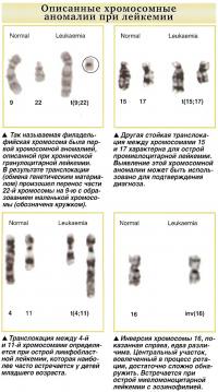 Описанные хромосомные аномалии при лейкемии