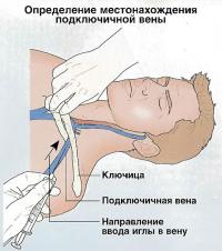 Определение местонахождения подключичной вены