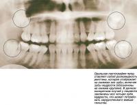 Оральная пантография представляет собой разновидность рентгена