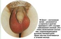 Орхит - воспаление яичек - развивается у взрослых мужчин примерно в 20% случаев заболевания свинкой