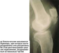 Оскольчатыми называются переломы, при которых кости раздроблены или расщеплены
