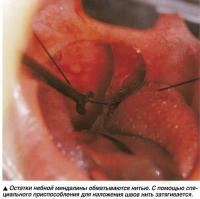 Остатки небной миндалины обматываются нитью