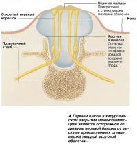 Осторожное отделение нервной бляшки от места прикрепления к стенке мешка твердой мозговой оболочки