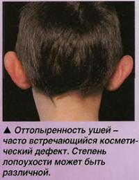 Оттопыренность ушей