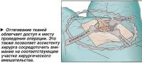 Оттягивание тканей облегчает доступ к месту проведения операции