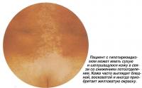Пациент с гипотиреоидизмом может иметь сухую и шелушащуюся кожу