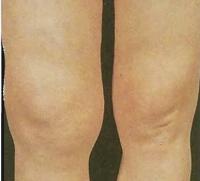 Пациент с инфектартритом, страдающий тяжелой формой разрушения коленных суставов