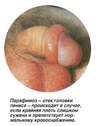Парафимоз - отек головки пениса