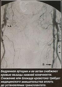 Патология бедренных артерий