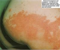 Пеленочный дерматит при кандидозе - это обычно поверхностная инфекция кожи