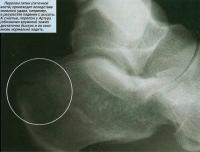 Перелом пятки (пяточной кости) происходит вследствие сильного удара