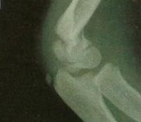 Перелом у Гарри можно видеть у конца плечевой кости, над локтевым суставом