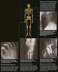 Переломы: шеи, кисти, лучевой кости и шейки бедра