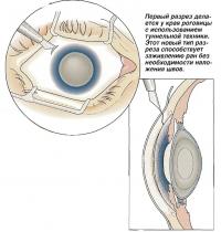 Первый разрез делается у края роговицы с использованием туннельной техники