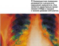 Пневмоцистная пневмония развивается в результате нарушения иммунитета