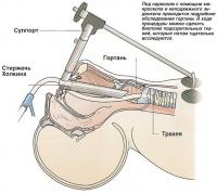 Под наркозом с помощью микроскопа и эндоскопа проводится обследование гортани