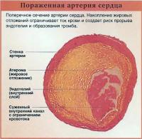 Пораженная артерия сердца