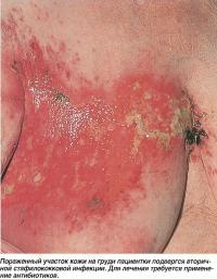 Пораженный участок кожи на груди пациентки подвергся вторичной стафилококковой инфекции
