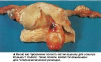 После гистерэктомии полость матки вскрыта для осмотра большого полипа