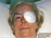 После операции глаз накрыт повязкой