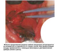 После продолжения разреза небная миндалина ретрагируется и отделяется от стенки глотки
