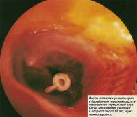 После установки ушного шунта восстанавливается нормальный слух
