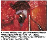 После затвердения цемента металлическая головка устанавливается в ПВП-чашку