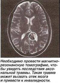 Последствия аксональной травмы