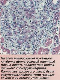 Последствия инфекционного гломерулонефрита