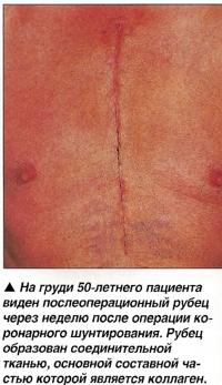 Послеоперационный рубец