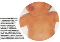 Появление желтухи у новорожденных случается очень часто