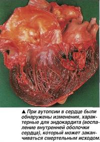 При аутопсии в сердце были обнаружены изменения, характерные для эндокардита
