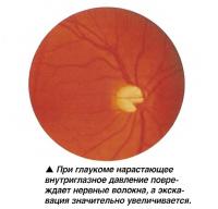 При глаукоме нарастающее внутриглазное давление повреждает нервные волокна