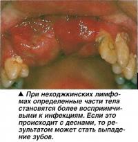 При неходжкинских лимфомах определенные части тела становятся восприимчивыми к инфекциям
