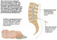 При поясничном проколе спинная жидкость (CSF) берется при помощи иглы