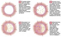 Причина инфаркта