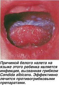 Причиной белого налета на языке является инфекция, вызванная грибком Candida albicans