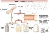 Принцип диализа одинаков для гемодиализа и перитонеального диализа