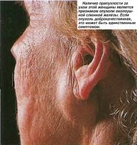 Припухлость за ухом является признаком опухоли околоушной слюнной железы