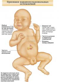 Признаки кардиопульмональных осложнений
