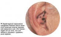 Признаком синдрома Рамсея Ханта является наличие очагов поражения вирусом в ухе