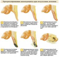 Прогрессирование аппендицита при отсутствии лечения