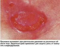 Пролежни возникают при длительном давлении на различные области тела