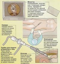 Проведение лапароскопии