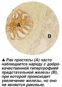 Рак простаты часто наблюдается наряду с доброкачественной гипертрофией предстательной железы