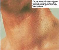 Рак щитовидной железы может вызвать опухоль на шее